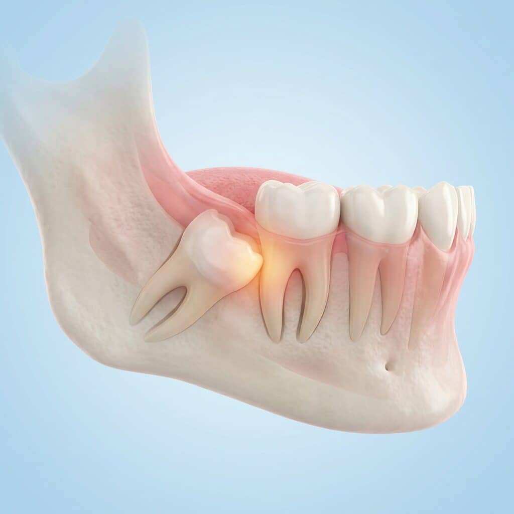 Illustration of an impacted wisdom tooth pressing against a molar, The Harmony Dental Group, Norwalk, CT